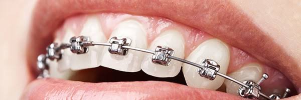 Self-Ligating Braces - Dental Planet